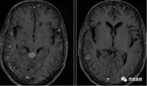 原发性中枢神经系统淋巴瘤-9