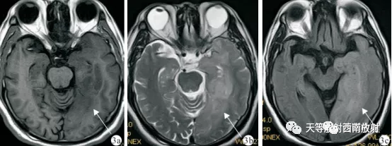 原发性中枢神经系统淋巴瘤-10
