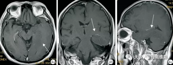 原发性中枢神经系统淋巴瘤-11