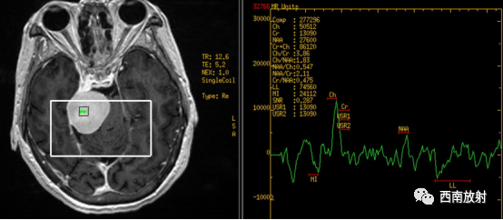 原发性中枢神经系统淋巴瘤-13