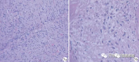 原发性中枢神经系统淋巴瘤-12