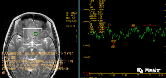 原发性中枢神经系统淋巴瘤-15
