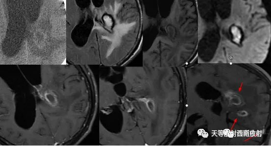 原发性中枢神经系统淋巴瘤-16