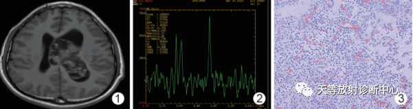 中枢神经细胞瘤-3
