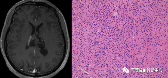 中枢神经细胞瘤-4