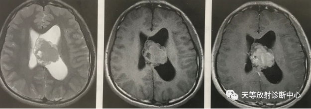 中枢神经细胞瘤-2