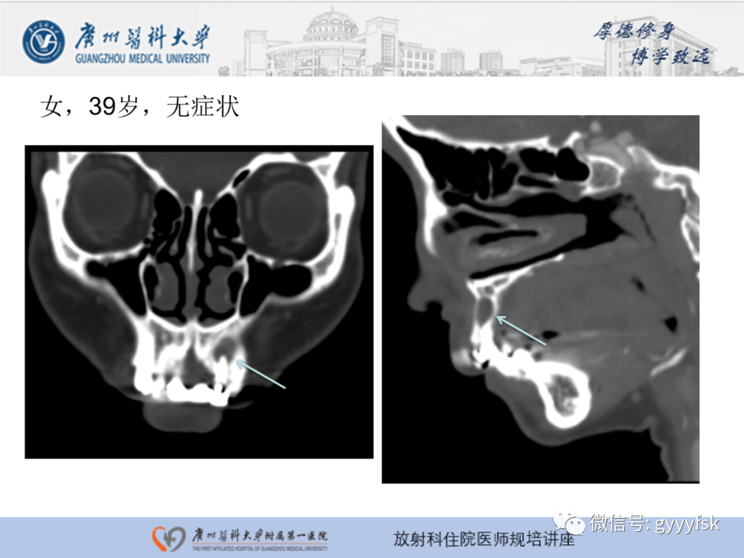 【PPT】颌骨常见病变的CT表现-7