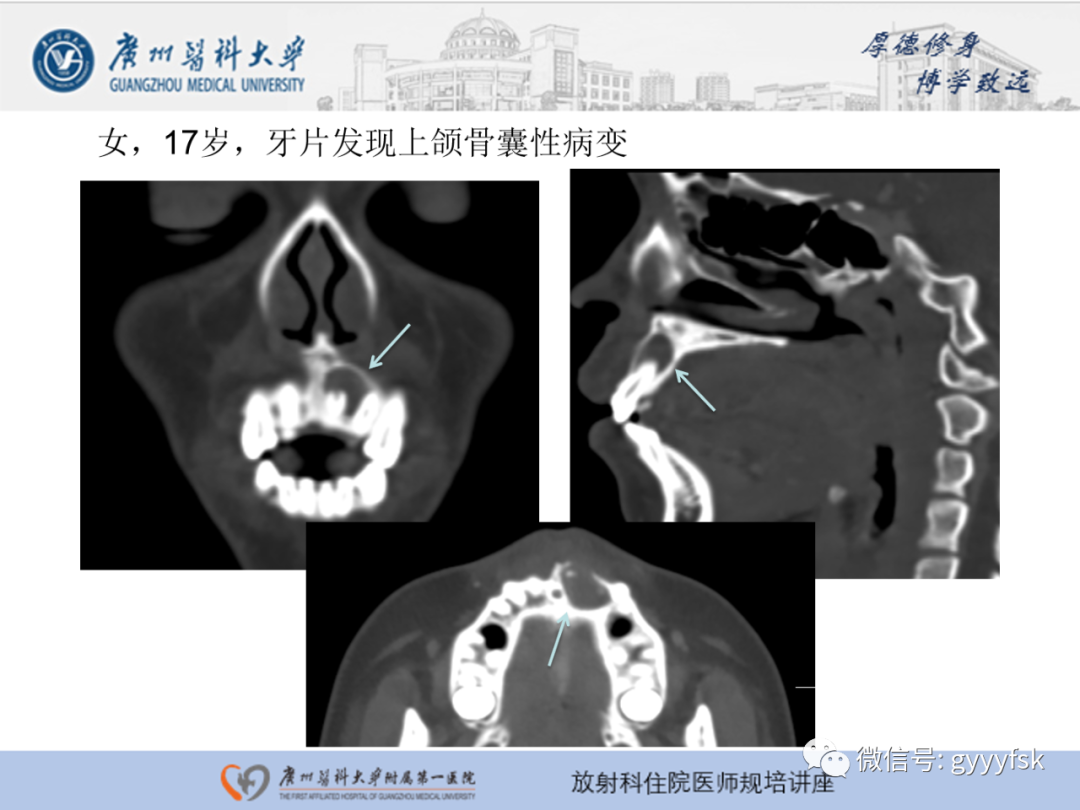 【PPT】颌骨常见病变的CT表现-8