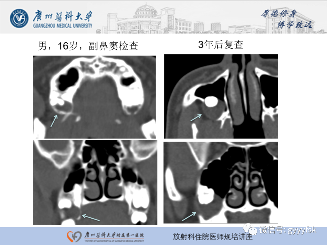 【PPT】颌骨常见病变的CT表现-10