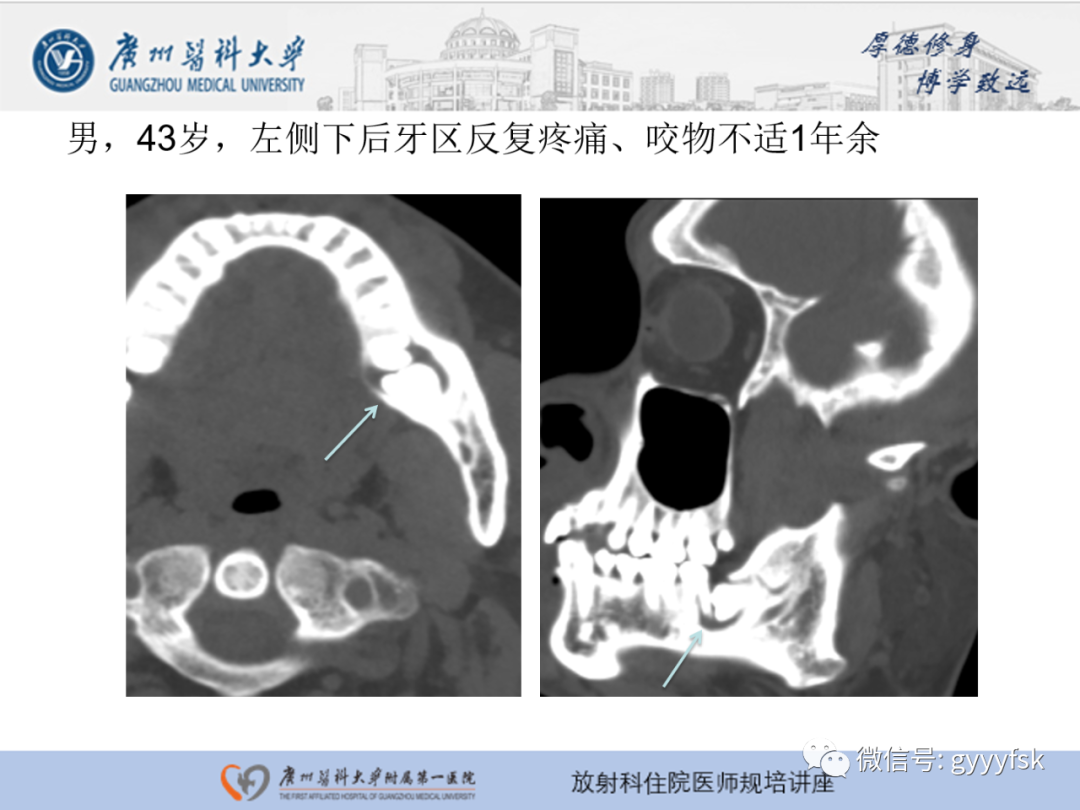 【PPT】颌骨常见病变的CT表现-11