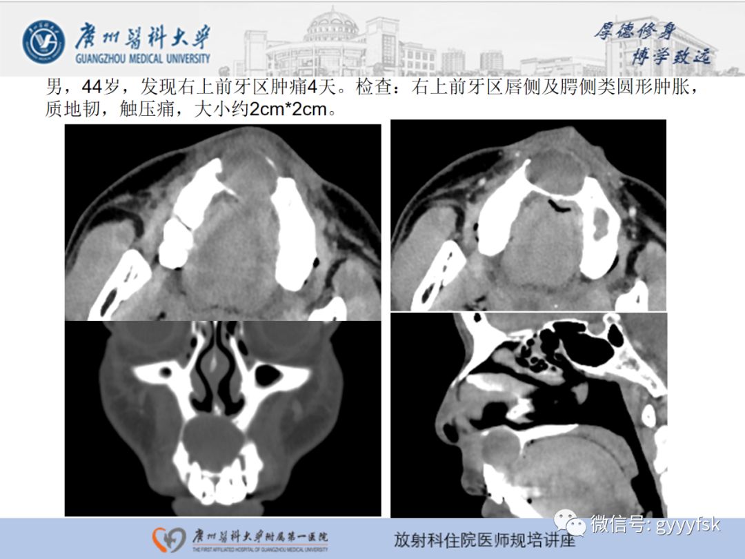 【PPT】颌骨常见病变的CT表现-13