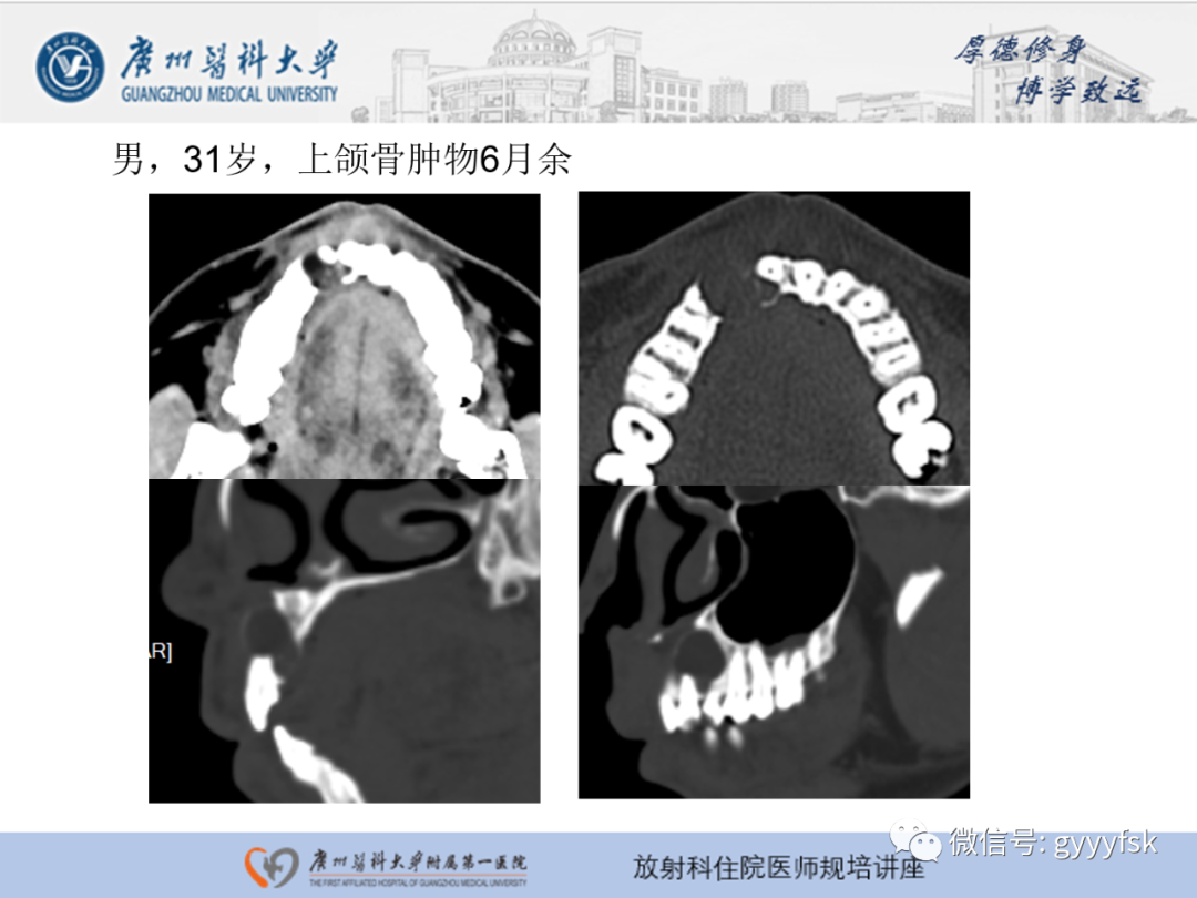 【PPT】颌骨常见病变的CT表现-14