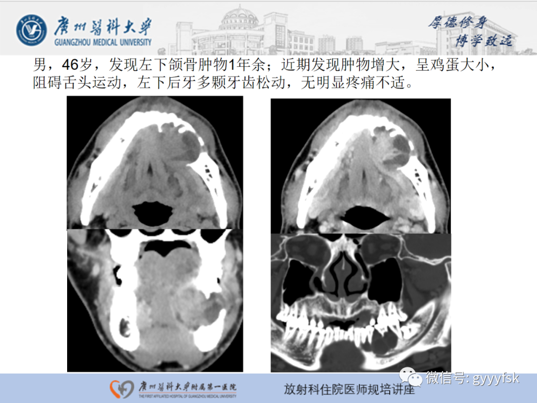 【PPT】颌骨常见病变的CT表现-16