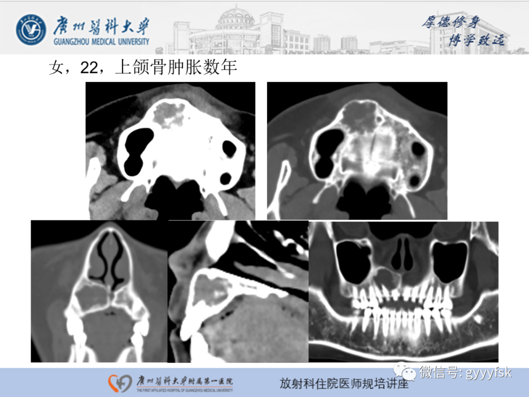 【PPT】颌骨常见病变的CT表现-21