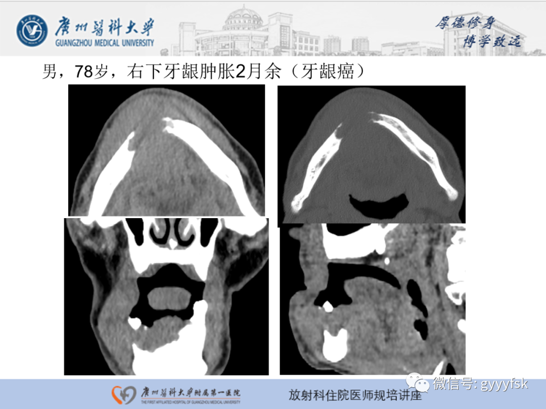 【PPT】颌骨常见病变的CT表现-23