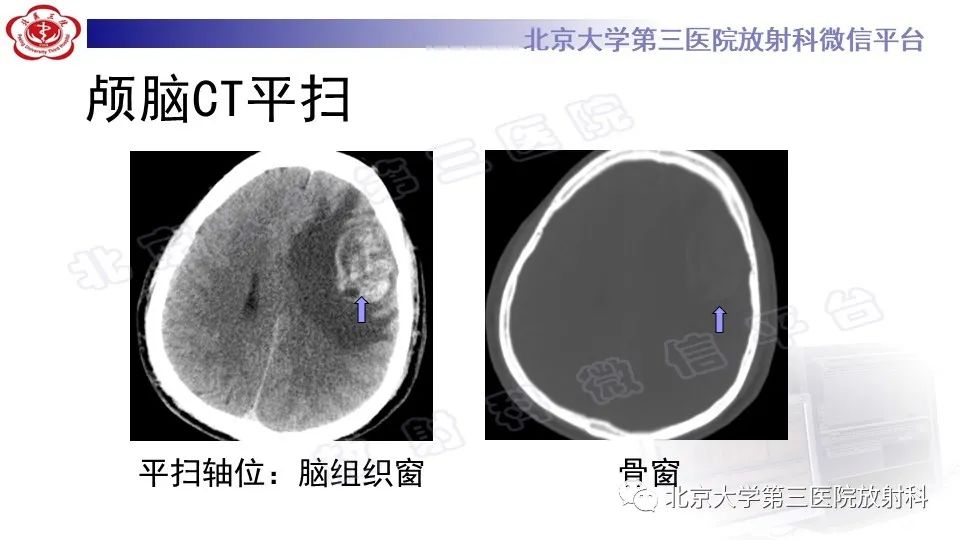 【PPT】间变性脑膜瘤-3