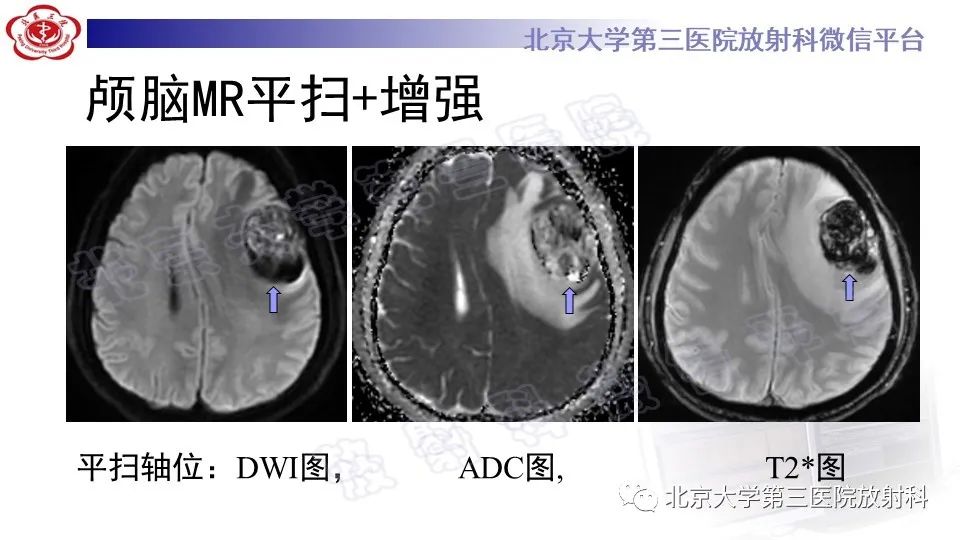 【PPT】间变性脑膜瘤-5