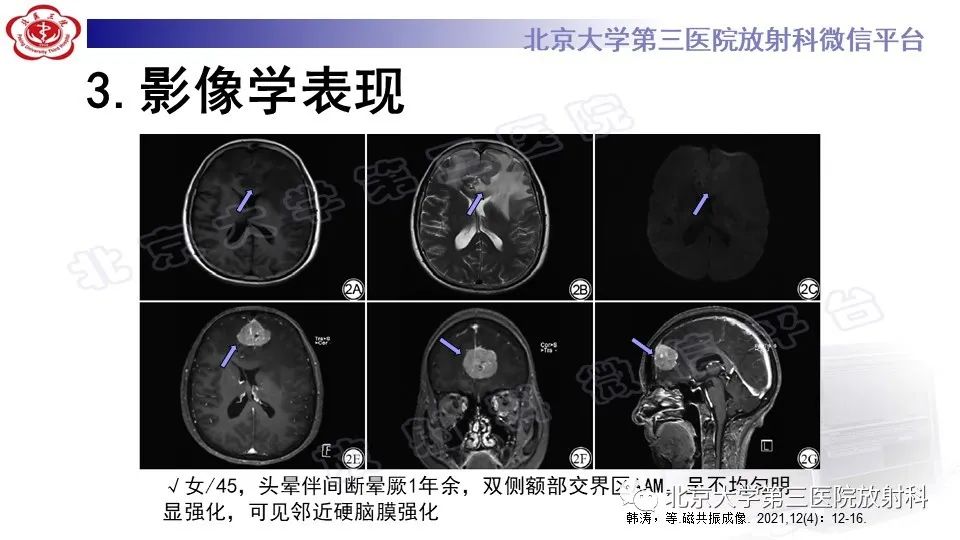 【PPT】间变性脑膜瘤-19