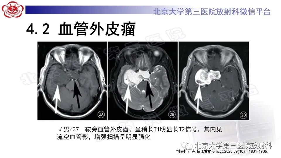 【PPT】间变性脑膜瘤-25