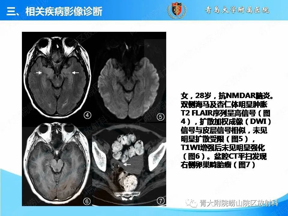 【PPT】自身免疫性脑炎的影像诊断与鉴别-16
