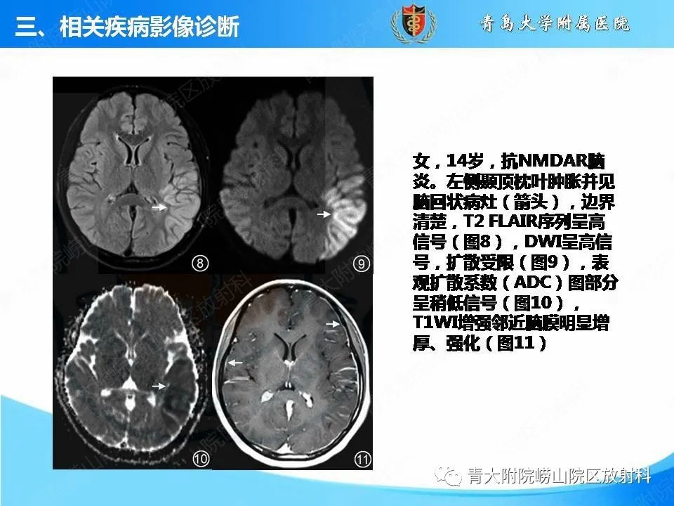 【PPT】自身免疫性脑炎的影像诊断与鉴别-17