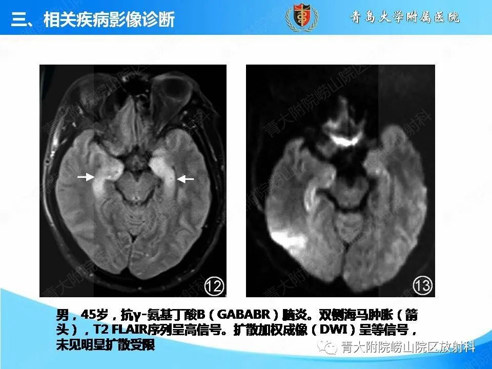 【PPT】自身免疫性脑炎的影像诊断与鉴别-19