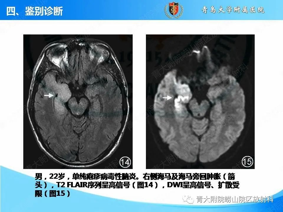 【PPT】自身免疫性脑炎的影像诊断与鉴别-22