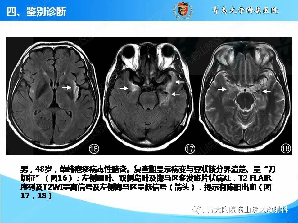 【PPT】自身免疫性脑炎的影像诊断与鉴别-23