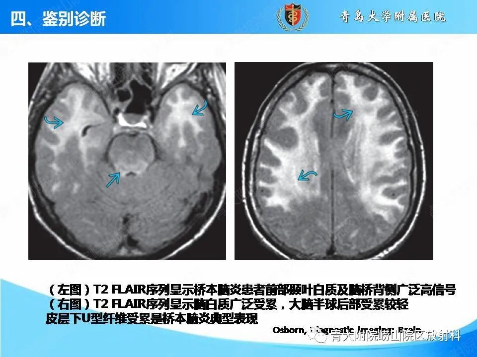 【PPT】自身免疫性脑炎的影像诊断与鉴别-25