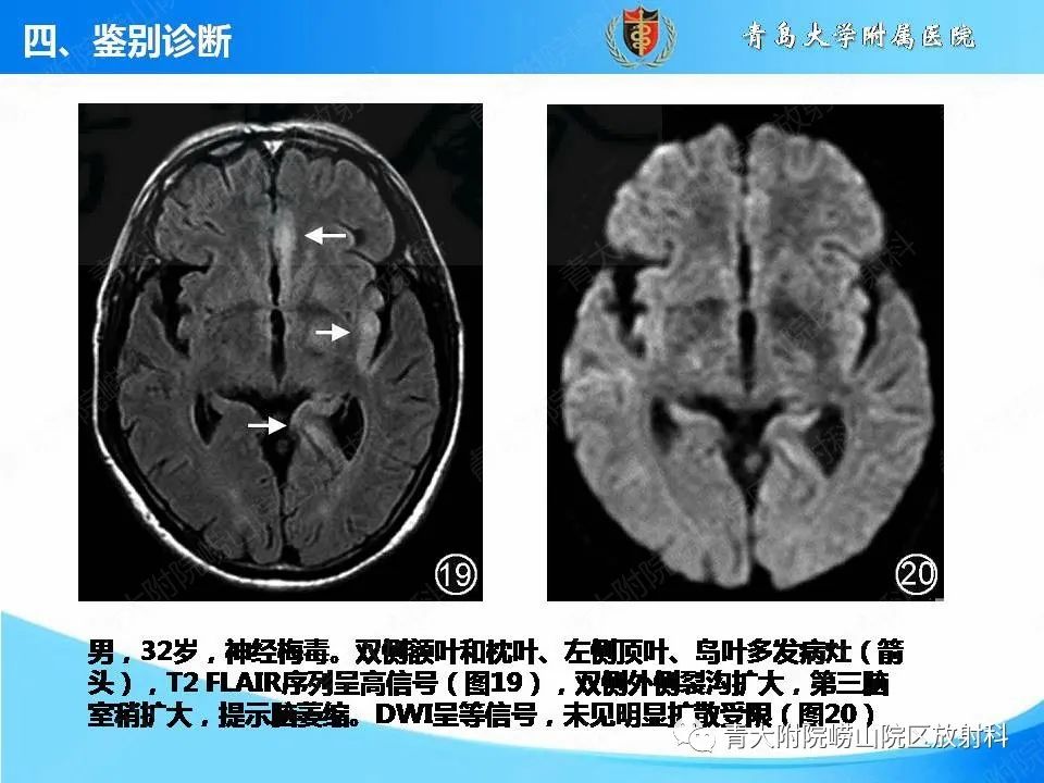 【PPT】自身免疫性脑炎的影像诊断与鉴别-27