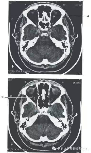 头部正常影像数据