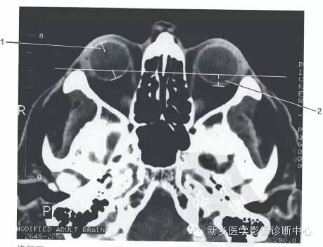 眼眶的正常数据
