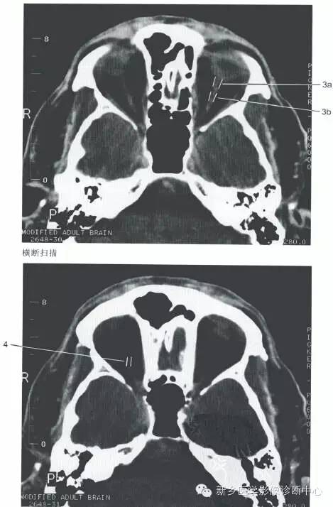 眼眶的正常数据