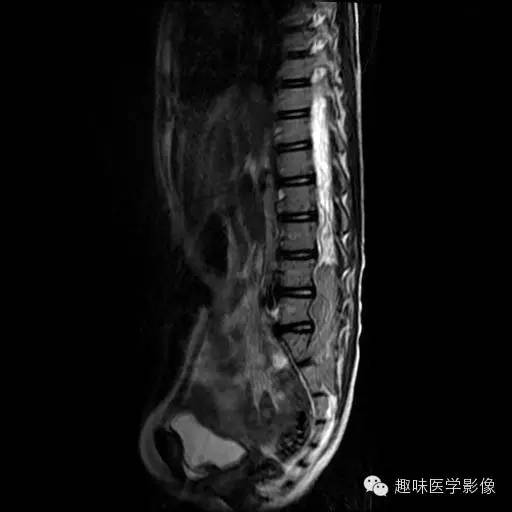 【病例】椎管内恶性神经鞘瘤1例MR影像表现