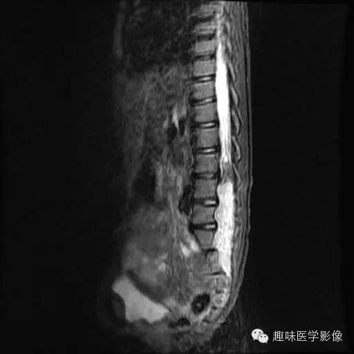 【病例】椎管内恶性神经鞘瘤1例MR影像表现