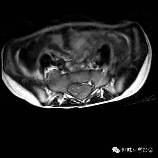 【病例】椎管内恶性神经鞘瘤1例MR影像表现