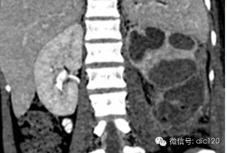 肾脏肿瘤的CT诊断与鉴别