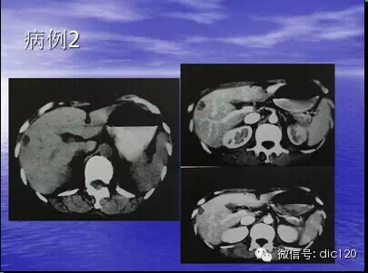 肝脏炎性假瘤的CT诊断