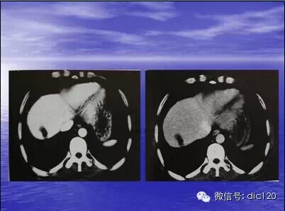 肝脏炎性假瘤的CT诊断