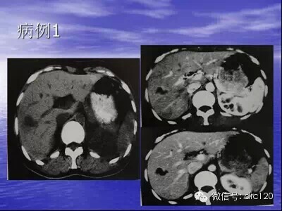 肝脏炎性假瘤的CT诊断