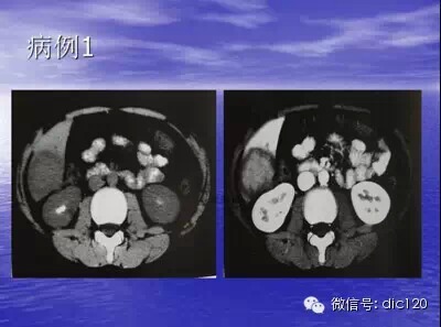 肝脏炎性假瘤的CT诊断