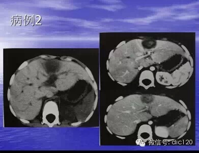 肝脏炎性假瘤的CT诊断