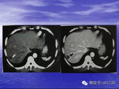 肝脏炎性假瘤的CT诊断