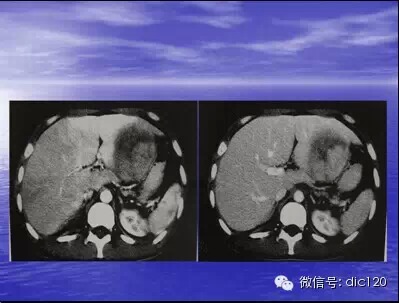 肝脏炎性假瘤的CT诊断