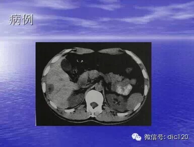 肝脏炎性假瘤的CT诊断