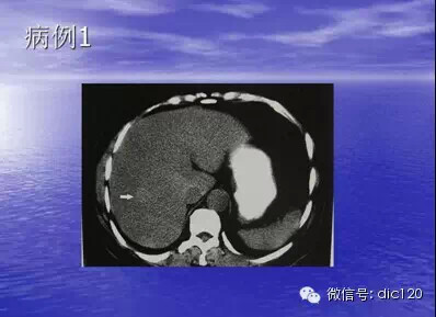 肝脏炎性假瘤的CT诊断