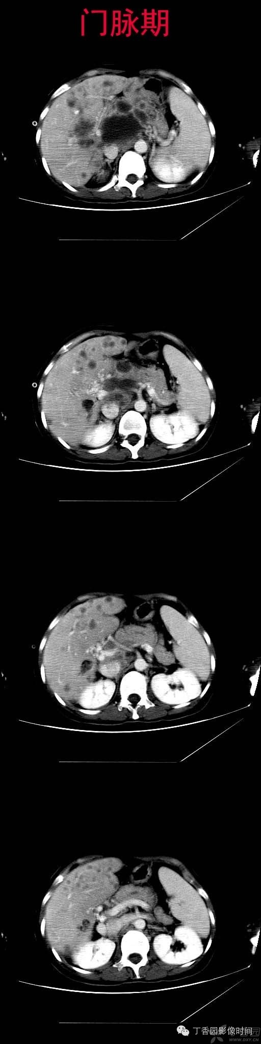 门静脉海绵样变的CT和MR表现