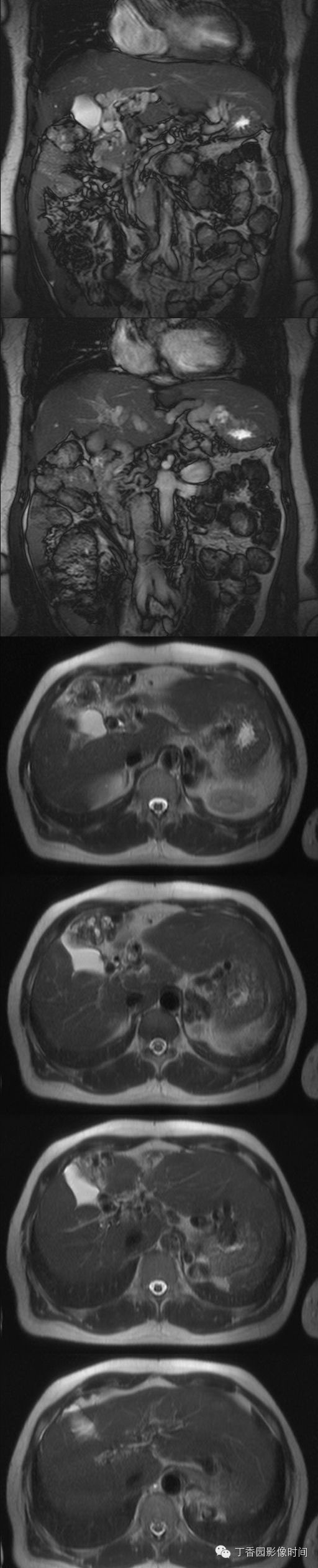门静脉海绵样变的CT和MR表现