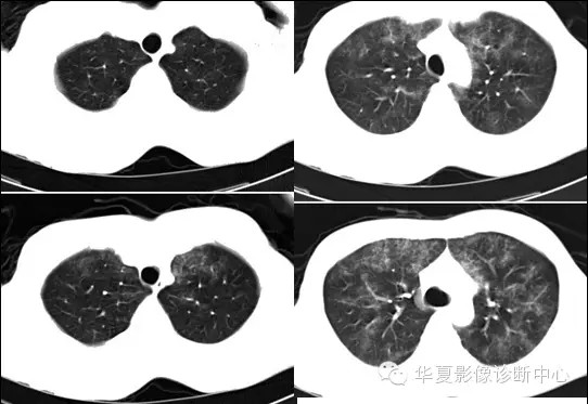 【病例学习】肺脂肪栓塞综合征一例CT诊断