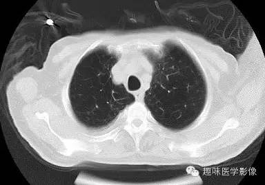 【病例】肺脓肿1例CT影像特点